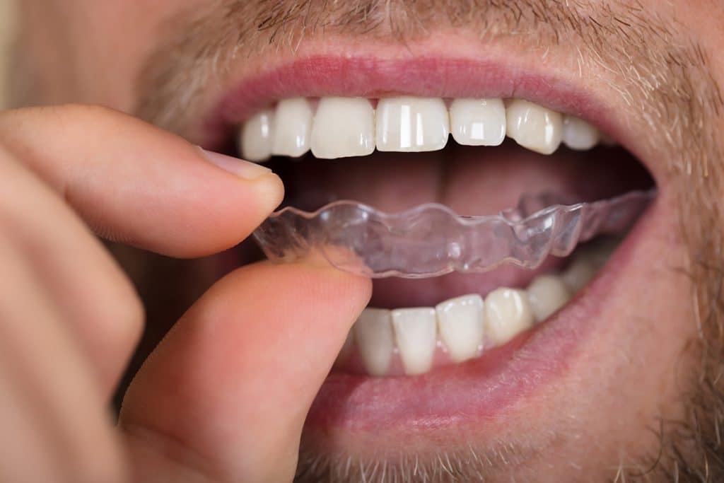 How Much Does Invisalign Cost In Greer, SC?