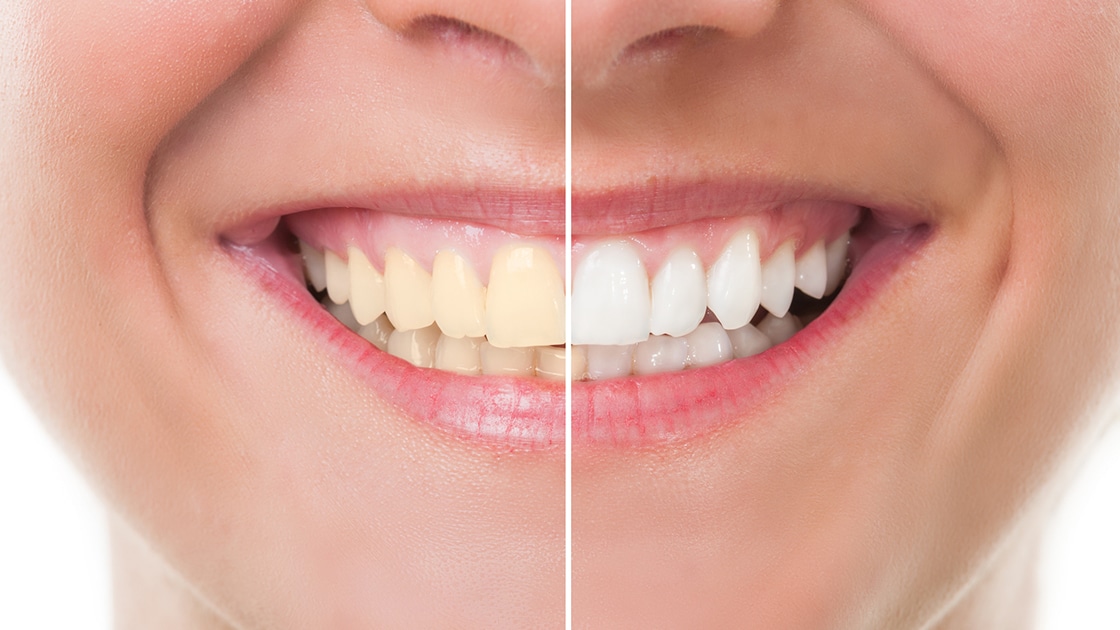 Before and After Image of Whitened Teeth